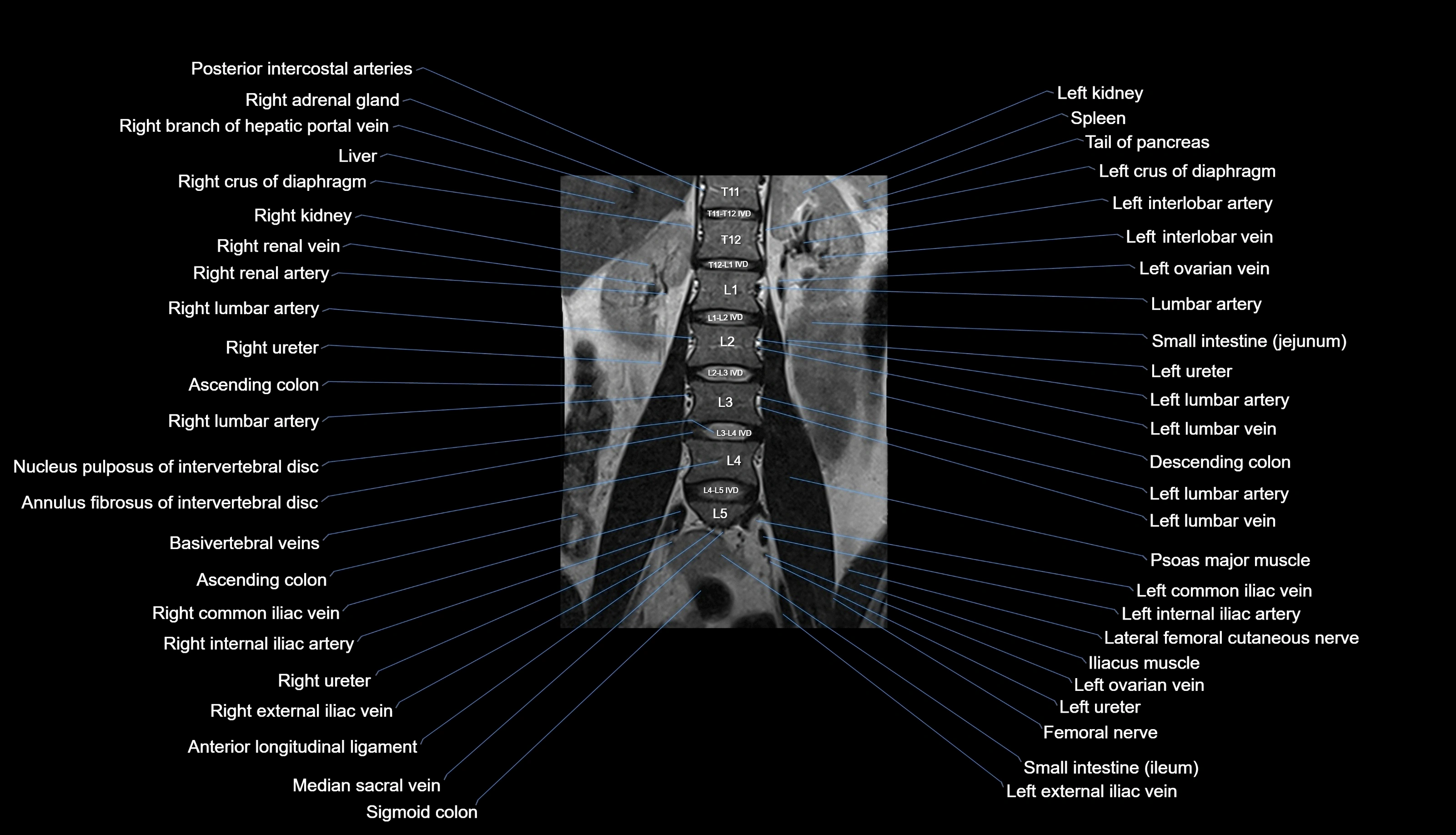 MRI lumbar spine labelled coronal cross sectional anatomy 3T radiology-img-00001-00011.webp